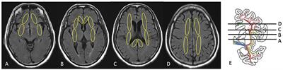 White matter hyperintensities in cholinergic pathways are associated with dementia severity in e4 carriers but not in non-carriers